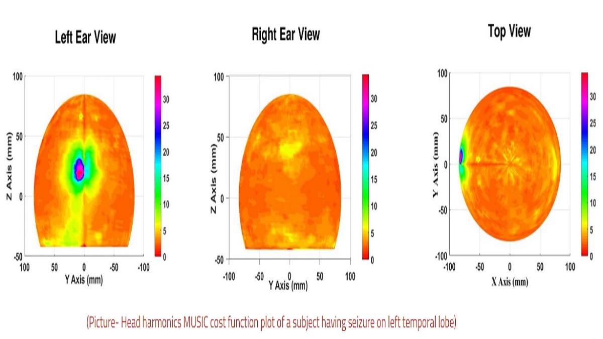 IIT Delhi develops non-invasive tool to detect epilepsy